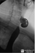 Killian-Jamieson Diverticulum